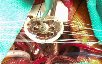 Mitral and Tricuspid Valve Repair with FlexForm™ Annuloplasty Band