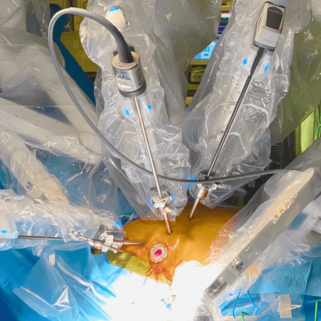 genesee-biomedical-robotic-cardiac-surgery-procedure Close-up of robotic-assisted cardiac surgery being performed on a patient.